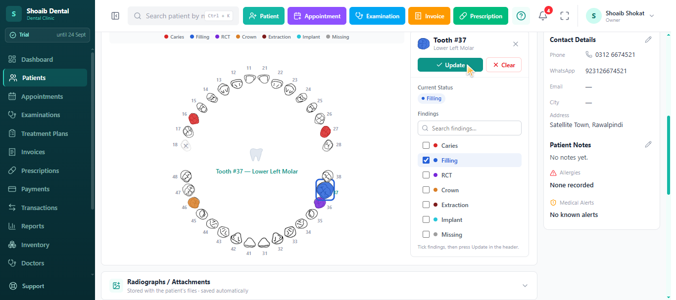jDent Interactive Dental Chart - Click a tooth, tick the finding - caries, filling, RCT, crown, extract