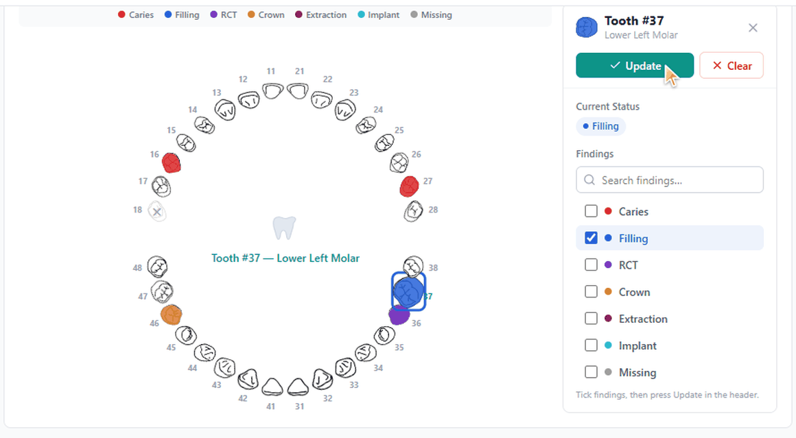 jDent dental charting screen - interactive tooth chart marking caries, fillings, RCT, crowns, extractions, implants and missing teeth per tooth